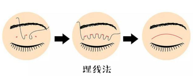 埋线双眼皮不取线一辈子有危害吗？价格参考