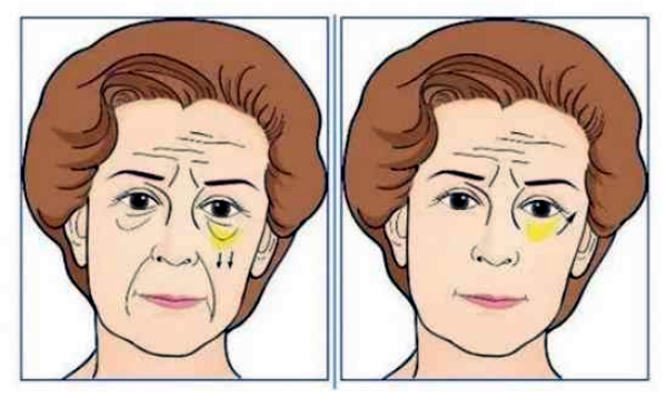 三、眼袋手术去除前后对比：手术方式与风险评估