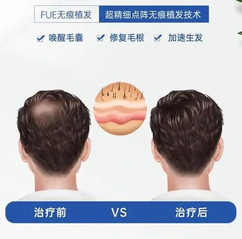 二、微针植发：价格区间在12–25元/毛囊单位