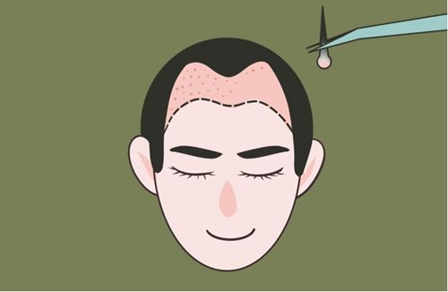 四、发际线调整：价格区间在13–28元/毛囊单位