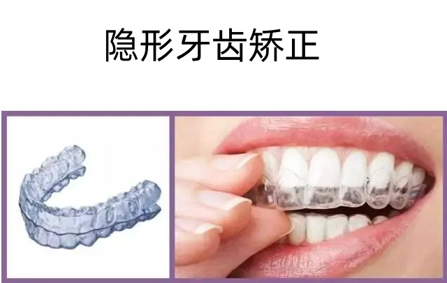 七、舌侧隐形矫正