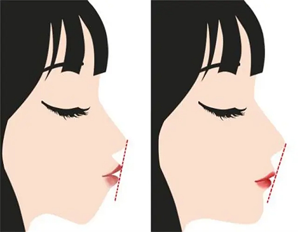 五、柳春明正颌手术术后时间多久