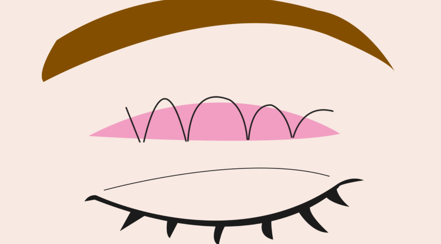 三、悦升线和埋线提升区别：术后风险与护理要点