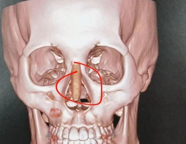 陈玉连整形医生做眼鼻修复真的靠谱吗？技术扎实不夸张，假体隆鼻价格3万-6万起，亲测术后自然无痕！