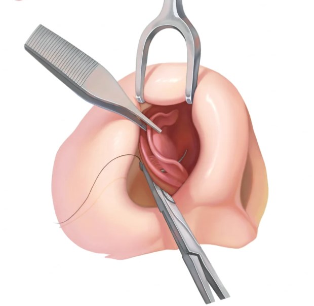 菲林普利隆鼻的缺点有哪些？3个月后60%用户反馈果冻感明显！