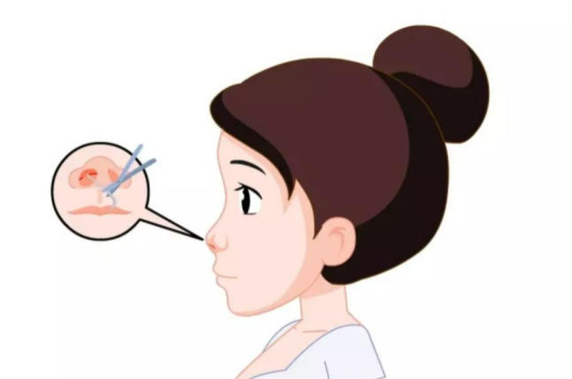 三、菲林普利隆鼻的缺点：疗效因人而异