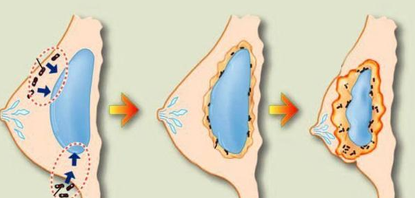 caidb整胸价格揭秘：2026年市场报价与风险全解析！手术前必看的7大隐患与真实案例分享