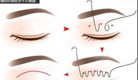 2026年优雅斯线雕pdtr6008用户真实反馈：80%满意率揭秘2-3年稳定效果！