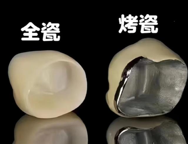 三、选择烤瓷牙的建议：兼顾美观与检查需求