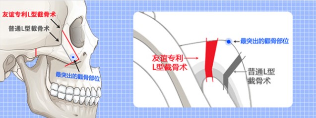 韩国365下颚细支怎么样？术后7天显脸小+自然不僵硬！18360元含3次复查，徐成益院长操作更安全！