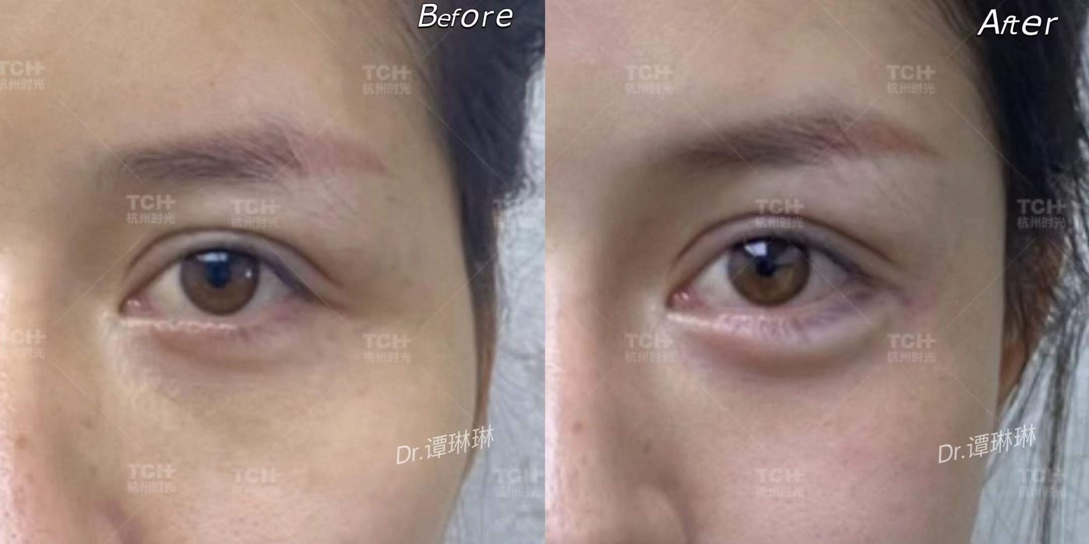 五、杭州陈小平时光医院磨骨手术的预约与注意事项