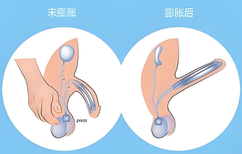 成年人透明保持器做到6会使7延长吗？专业解答+常见疑问全解析
