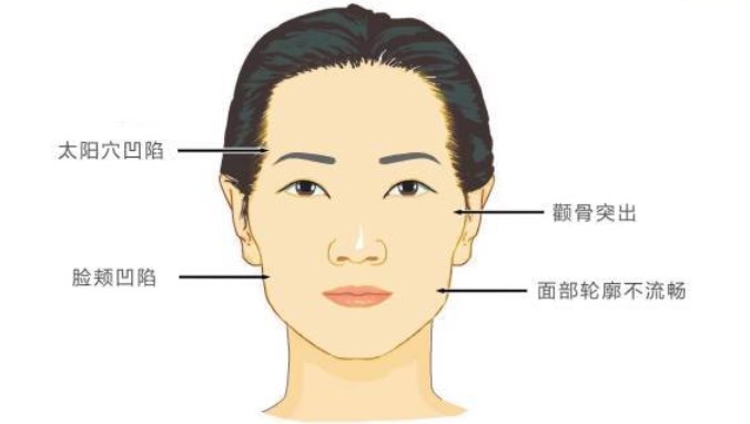 五、深圳梁晓健脂肪填充的真实实例与口碑评价