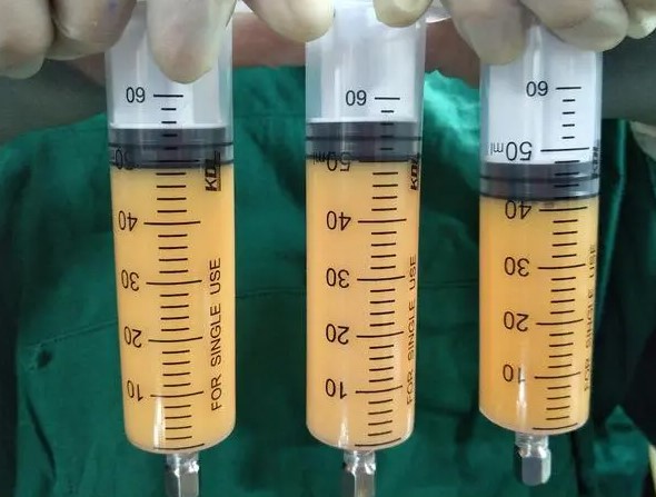 三、深圳梁晓健脂肪填充的价格体系与性价比分析