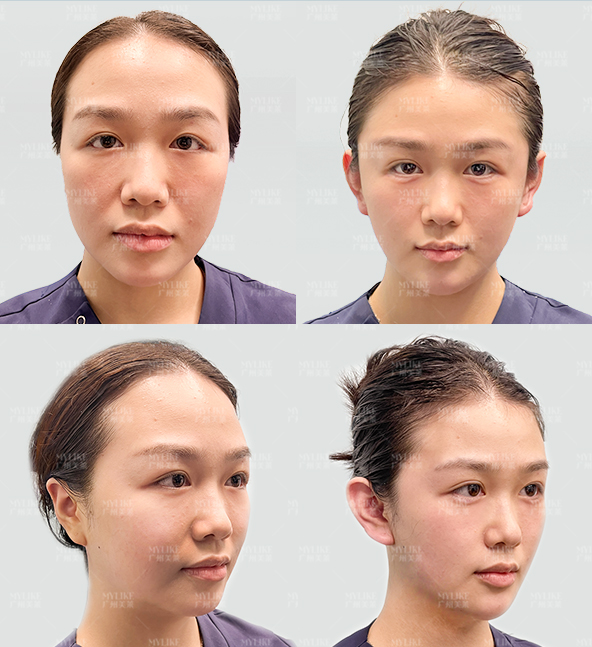 四、广州美莱光子嫩肤价格是否合理？用户评价与避坑指南