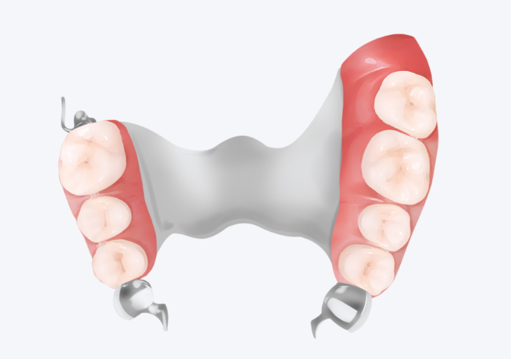 2026年钴铬合金假牙价格全公开！不同品牌多少钱一颗？选购避坑指南揭秘