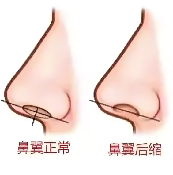 段焘鼻翼缩小：细节决定“蒜头鼻”修复