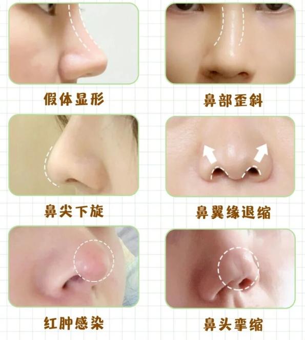 段焘鼻修复实例:真实疗效和期记录