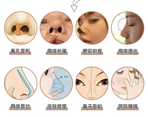 段焘鼻修复技术细节:这些参数你可能不知道