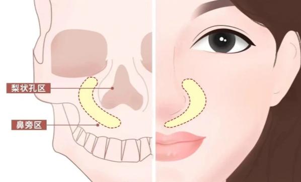 三、避免鼻基底增高导致脸变丑的科学方案