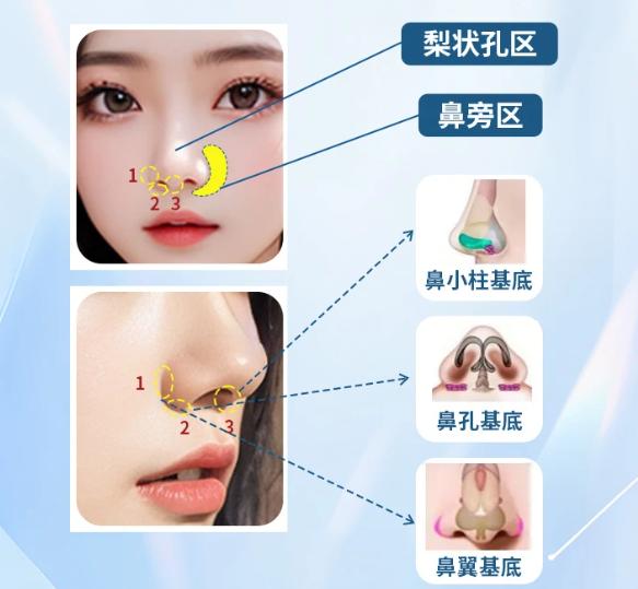 二、鼻基底增高导致脸部变丑的典型表现