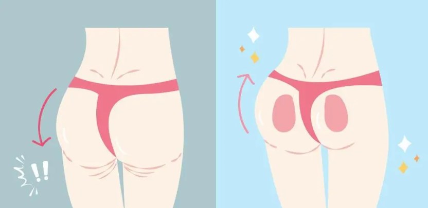 二、科学应对脂肪丰臀后臀部不翘的解决方案