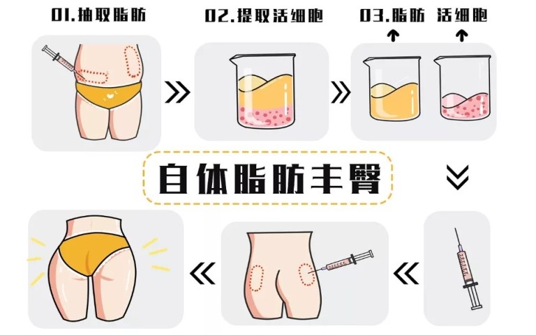 三、脂肪丰臀术后护理的三大误区及规避指南