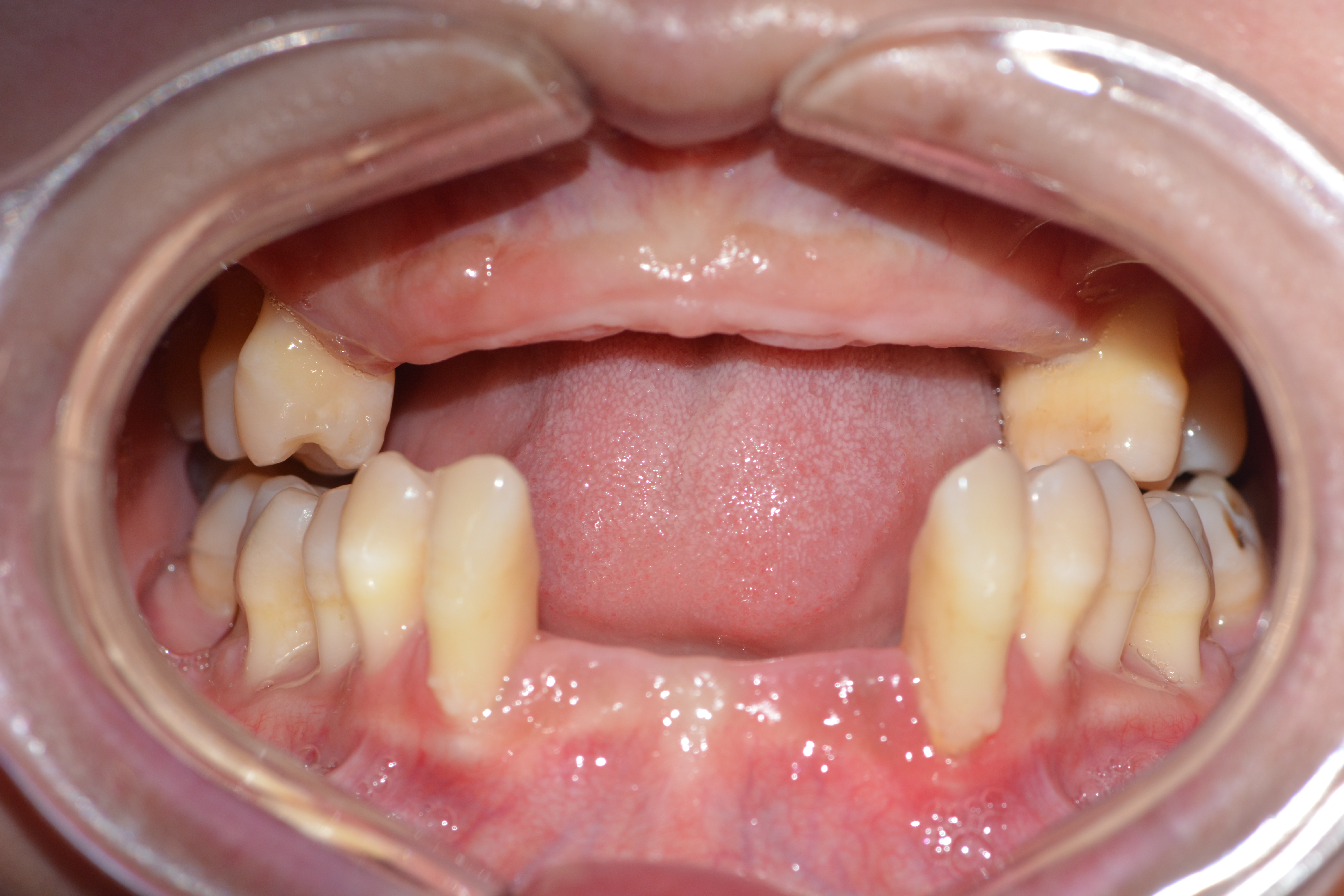 合肥美奥口腔种植牙医生做的怎么样？技术靠谱有案例支撑！