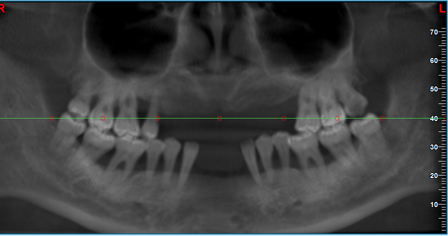 三、合肥美奥口腔种植牙医生实例：真实患者反馈与疗效