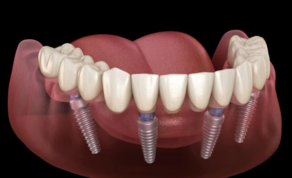 种植体与邻牙距离太近会有啥？5mm安全距离你必须知道