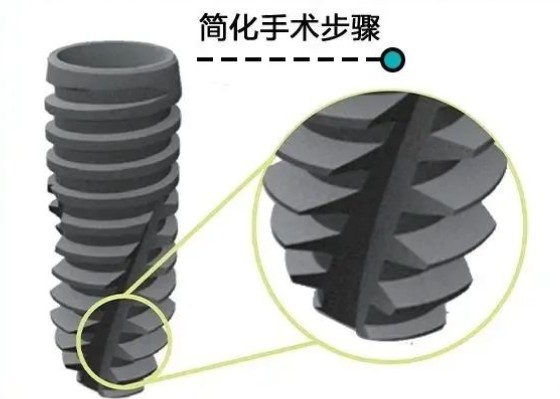 以色列ab种植体的寿命10-15年？对比科特斯价格更亲民！