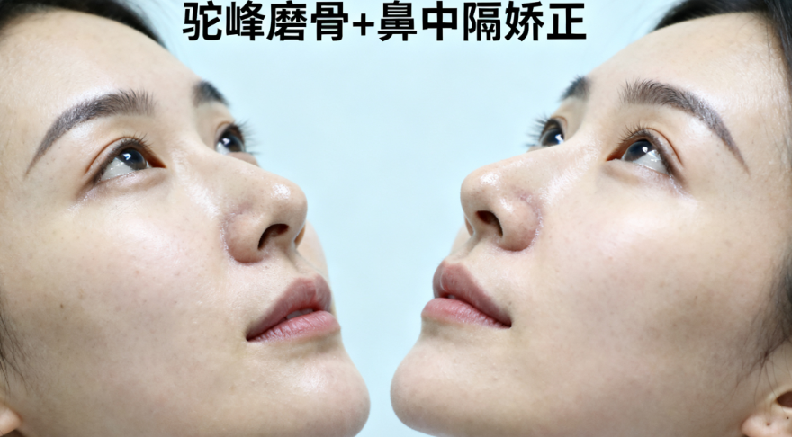 杨万忠和陈天杰赵博那个做鼻子比较好？全肋4.98万起vs硅胶1.5万起，鼻畸形修复选陈天杰！