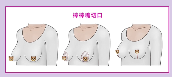 四、成都华美紫馨艾剑英医生2026年乳房修复技术前