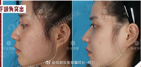 五、成都华美紫馨艾剑英医生乳房整形口碑测评