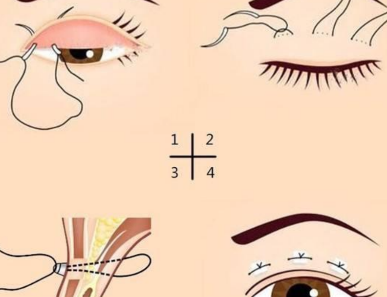 齐齐哈尔双眼皮哪位医生好？李云飞埋线2800元起自然无痕，魏林平全切9800元去脂快！