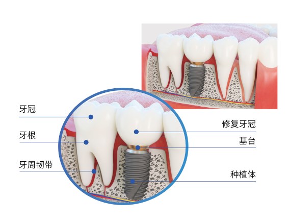 三、选择瑞典Astra EV种植体的注意事项