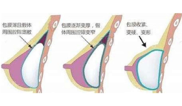 二、假体包膜挛缩的典型症状与诊断标准