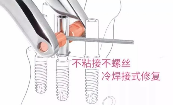 韩国奥齿泰亲水版和标准版的区别看这里！1000名患者反馈的骨整合成功率数据