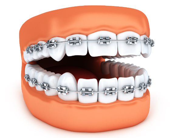 二、奥美科陶瓷非自锁托槽的适用人群分析