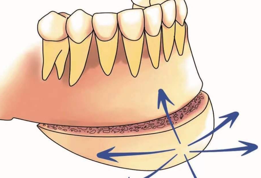 四、颏成型术：轻度下巴后缩的解决方案