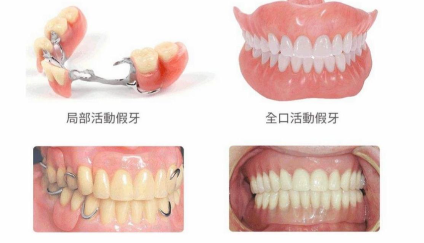 三、阿曼吉尔巴赫义齿价钱的对比分析