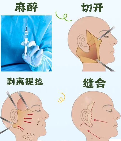 四、郭玉瑞拉皮手术的真实实例与用户反馈