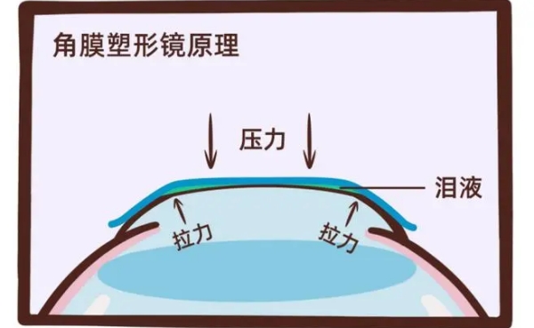 二、OK镜验配流程及医学原理解析