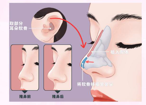三、段焘隆鼻的价格构成与技术附加值