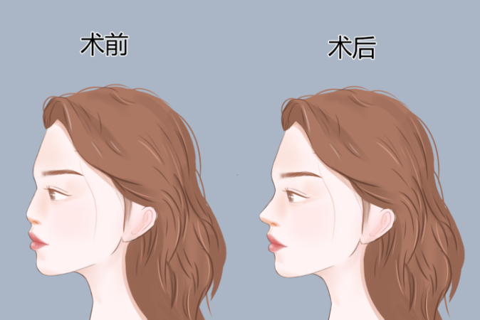 六、段焘隆鼻能分多次付款吗?成都西区医院支持分多次,术后管家服务确保