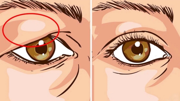 六、曹林上睑下垂矫正术后护理与注意事项