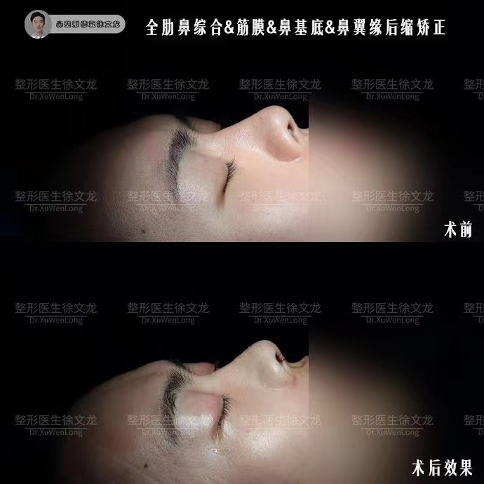 丽芙兰珍玻尿酸填充怎么选？上海伯思立3D骨相支撑、北京润美玉之光αPRP技术、成都华美紫馨92%满意度对比更稳