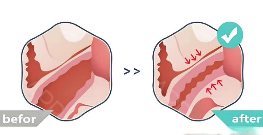 三、如何科学评估是否适合全段保留粘膜紧缩术？
