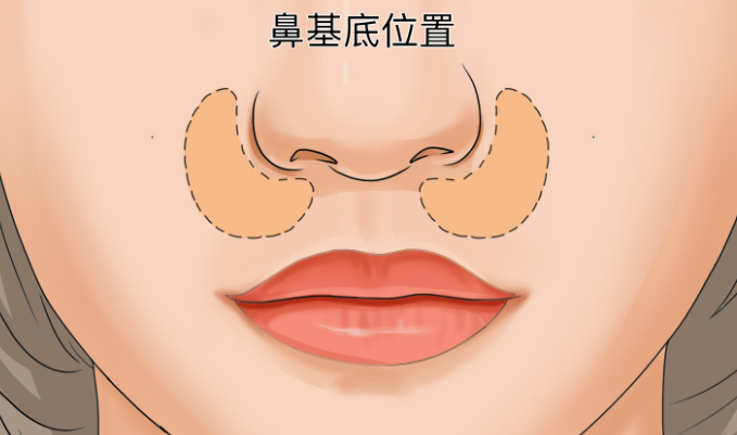 三、鼻基底填充操作要点与注意事项